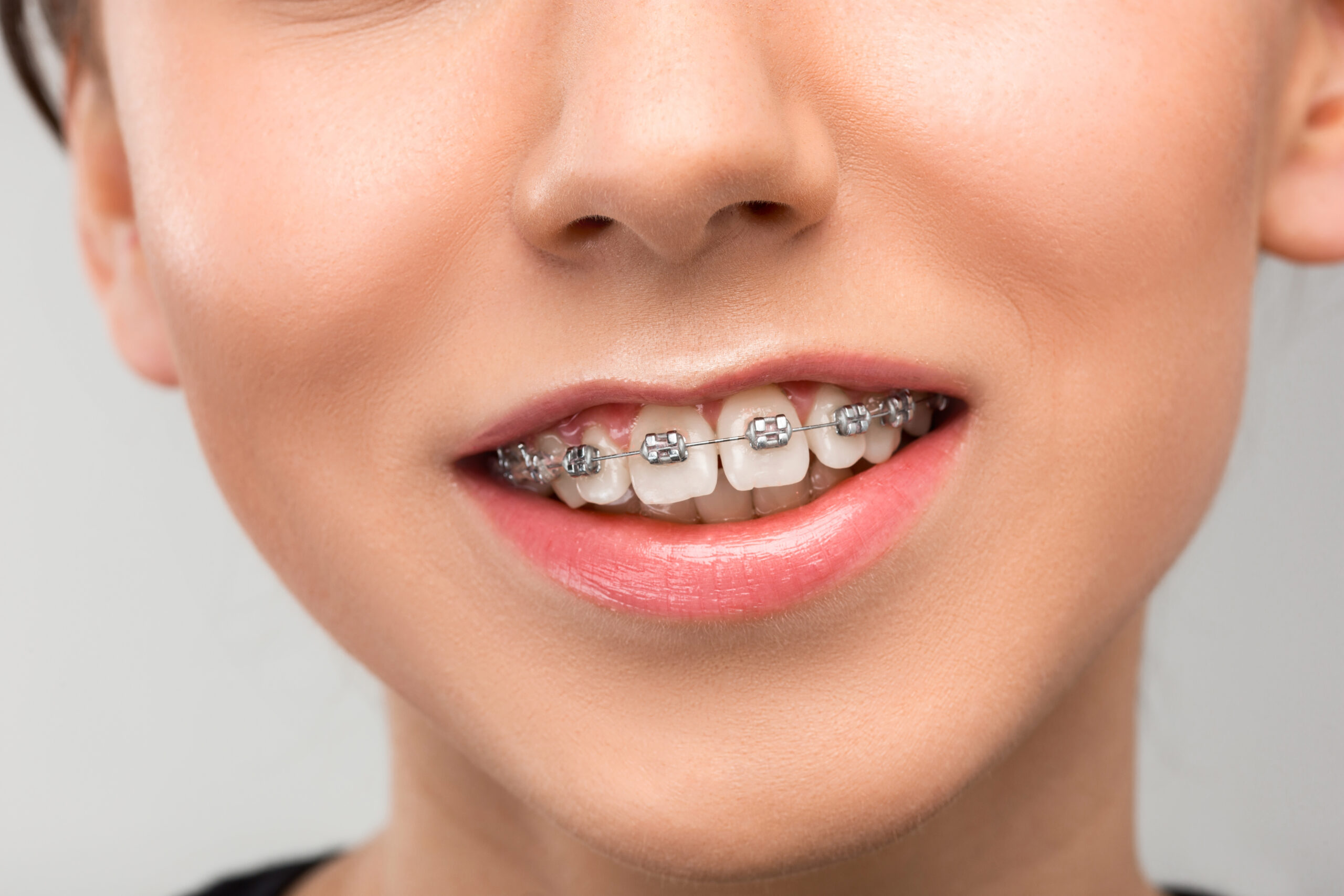 Pediatric Dentistry Insights: Signs Your Child Might Need Braces